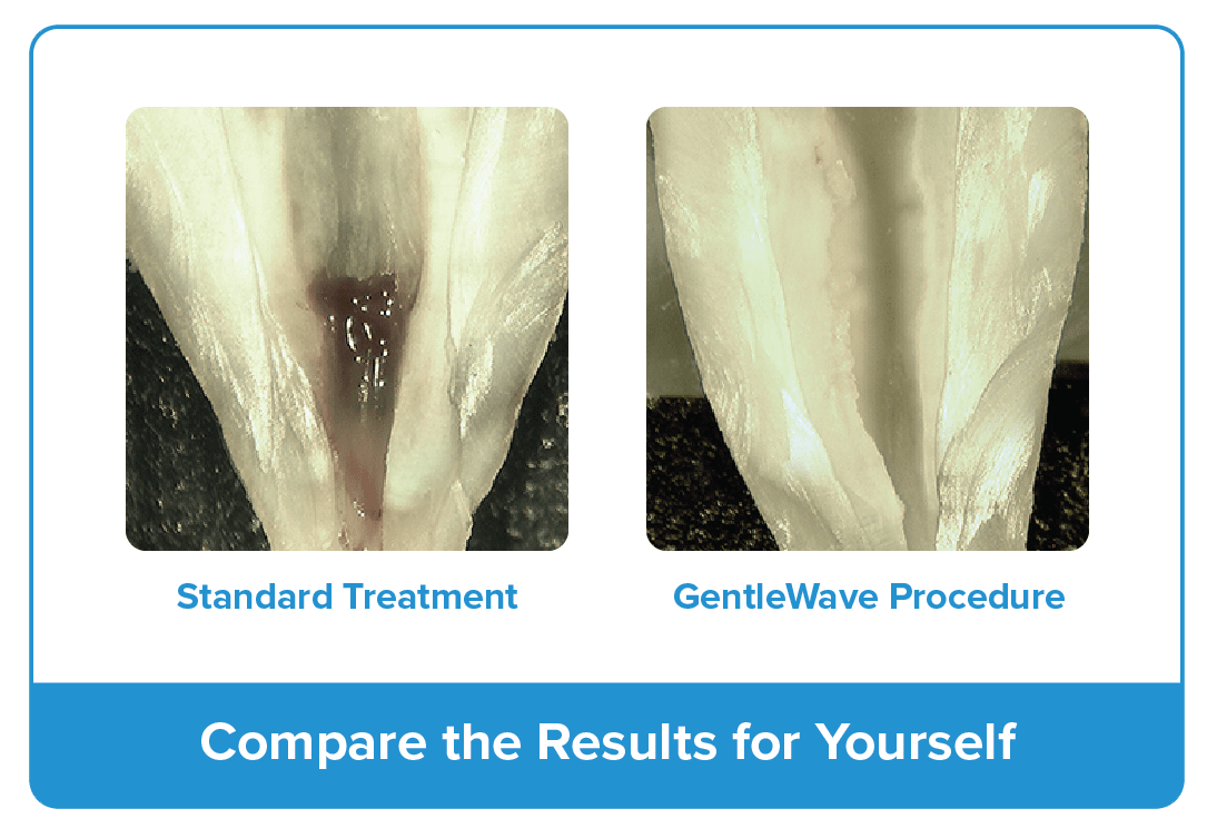 Image showing comparison between standard treatment and Gentle Wave Procedure