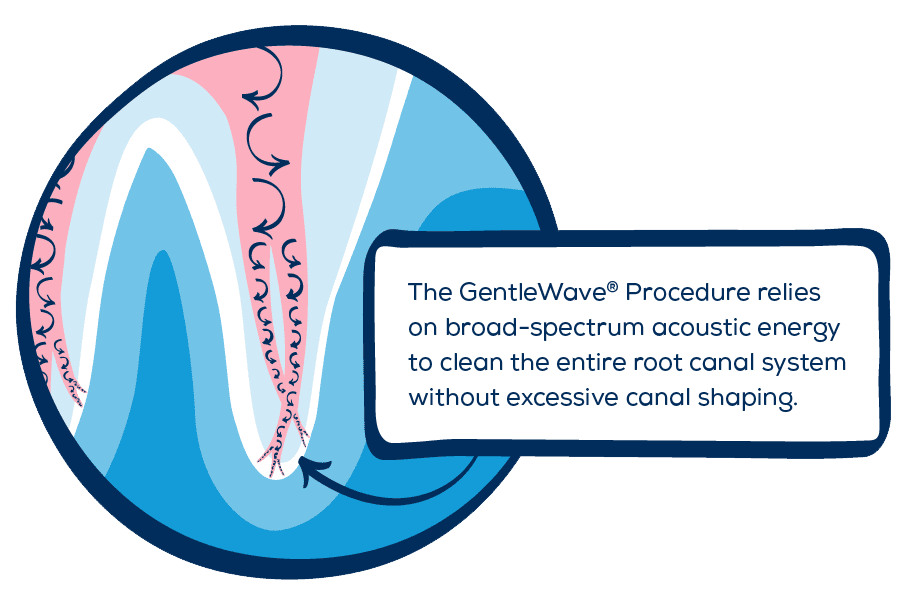 image of tooth with text "The GentleWave Procedure relies on broad-spectrum acoustic energy to clean the entire root canal system without excessive canal shaping"