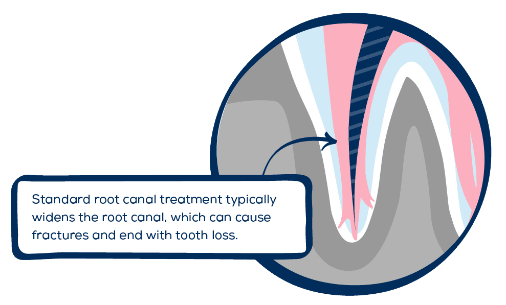 image of a tooth with the text "Standard root canal treatment typically widens the root canal, which can cause fractures and end with tooth loss"